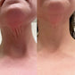 before and after of a customer who uses Frownies chin-up polypeptide mask 