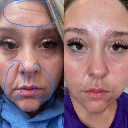 The image shows a side-by-side comparison of a girl's face before and after using Frownies CEM (corners of eyes and mouth) patches. On the left, the girl’s face has visible wrinkles around her eyes and mouth. On the right, after using the patches, her skin appears smoother with reduced wrinkles in those areas.