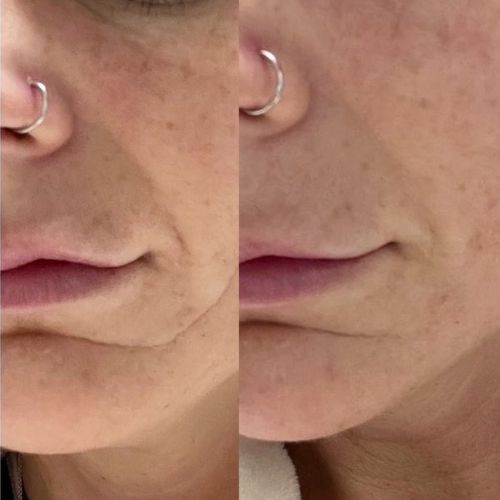 The image shows a side-by-side comparison of a girl's face before and after using Frownies CEM (corners of eyes and mouth) patches. On the left, the girl’s face has visible wrinkles around her eyes and mouth. On the right, after using the patches, her skin appears smoother with reduced wrinkles in those areas.