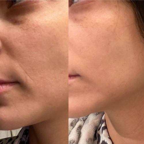 The image shows a side-by-side comparison of a girl's face before and after using Frownies CEM (corners of eyes and mouth) patches. On the left, the girl’s face has visible wrinkles around her eyes and mouth. On the right, after using the patches, her skin appears smoother with reduced wrinkles in those areas.