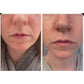 Before-and-after photo of a woman using Frownies Corners of Eyes and Mouth patches: The 'before' image shows noticeable eleven lines around her nose, while the 'after' image reveals these lines smoothed and softened.