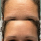 A man displays a before-and-after comparison showing the effects of using forehead and between-the-eyes patches. The ‘before’ photo shows visible wrinkles, while the ‘after’ photo shows a smoother, more relaxed appearance, illustrating the patches' effectiveness.