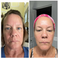 woman with mature skin before and after using Forehead & Between Eyes Wrinkle Patches Facial Patches Frownies to smooth 11 lines   