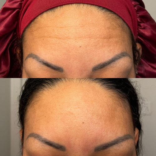 A woman displays a before-and-after comparison showing the effects of using forehead and between-the-eyes patches. The ‘before’ photo shows visible wrinkles, while the ‘after’ photo shows a smoother, more relaxed appearance, illustrating the patches' effectiveness.