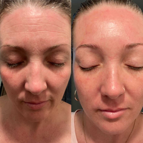 A woman displays a before-and-after comparison showing the effects of using forehead and between-the-eyes patches. The ‘before’ photo shows visible wrinkles, while the ‘after’ photo shows a smoother, more relaxed appearance, illustrating the patches' effectiveness.