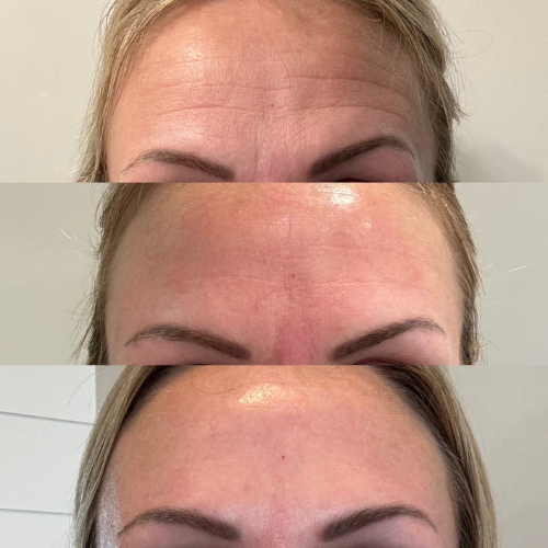 A woman displays a series of three images showing the effects of using forehead and between-the-eyes patches over time. The first image shows visible wrinkles, the second image shows some improvement, and the third image shows a significantly smoother, more relaxed appearance, illustrating the patches' effectiveness