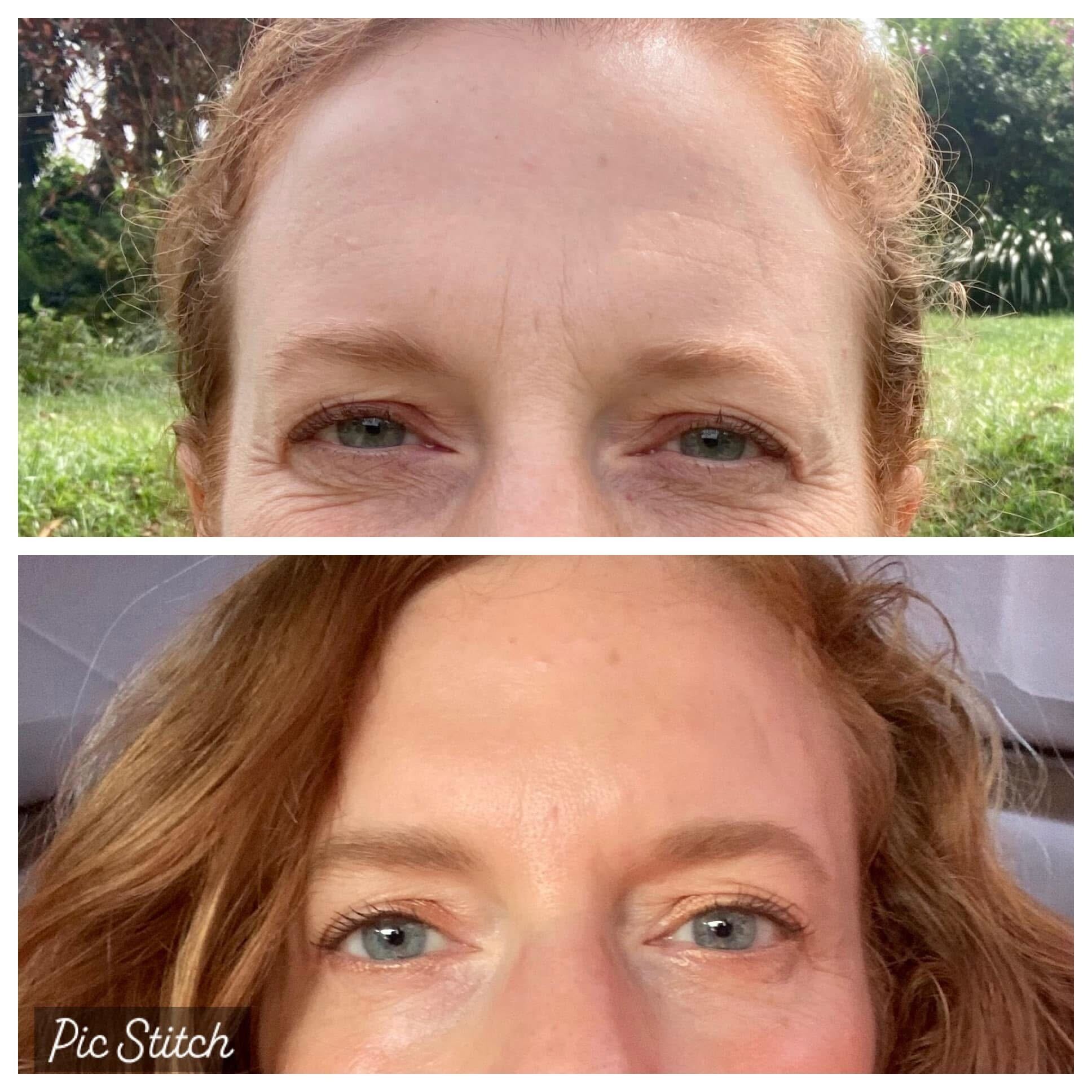 A customer showing her before and after pictures using the Frownies under eye gels. Showing her results and dark circles and fine lines softening