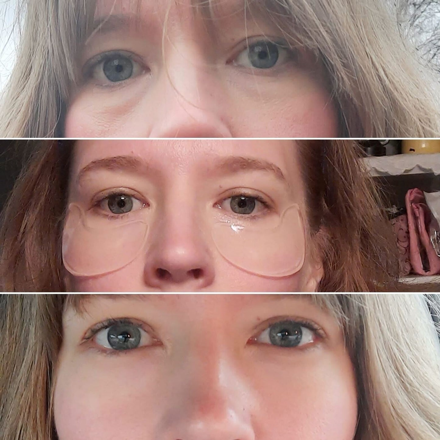 A customer showing her before and after results of using Frownies cactus collagen under eye gels 