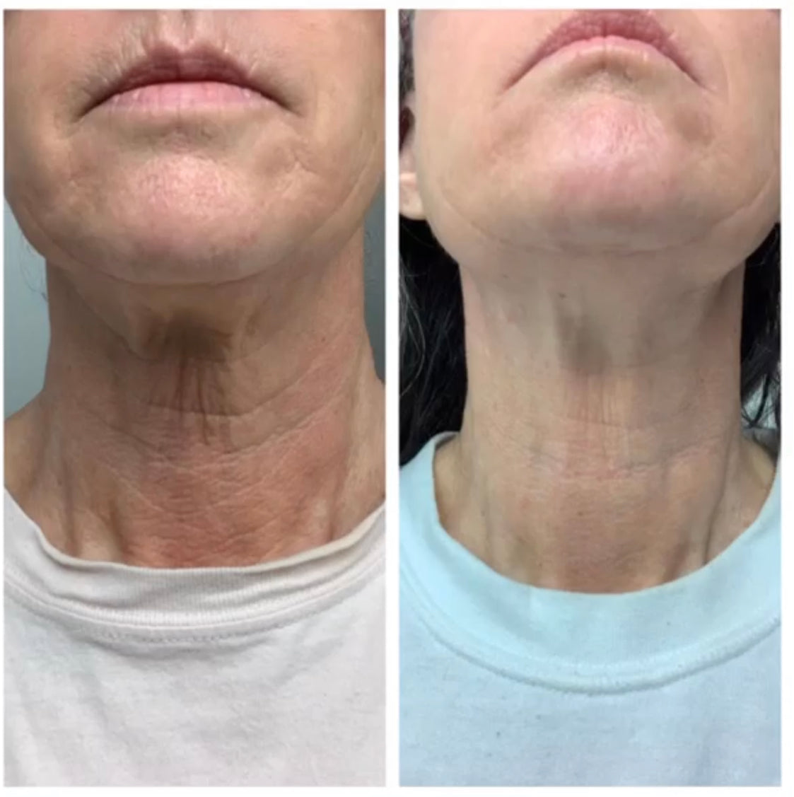 before and after of a customer who uses Frownies chin-up polypeptide mask 