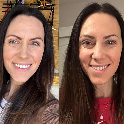 A before-and-after photo of a woman using Frownies facial patches, showing a noticeable difference in her skin with reduced fine lines and a smoother overall appearance.