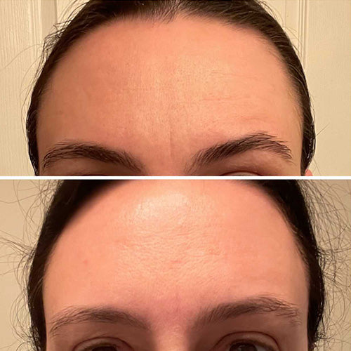 Forehead Between Eyes Wrinkle Patches